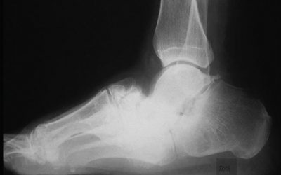 Los zapatos ortopédicos mejoran los parámetros espacio-temporales de la marcha en la ataxia de Friedreich