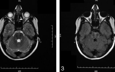 La Fundación de Ataxia Charlevoix-Saguenay selecciona un proyecto del Dr. Erceg