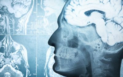 ¿Por qué sólo ciertas células del cerebro se dañan en la Ataxia de Friedreich?