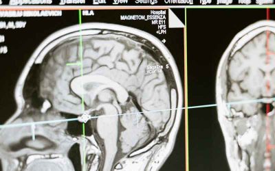 Guía práctica de ataxias y paraparesias espásticas hereditarias en consulta