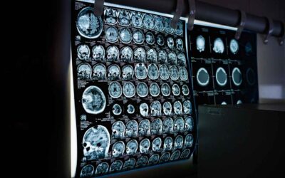 DT-216P2 muestra signos tempranos de beneficio en el ensayo clínico de ataxia de Friedreich